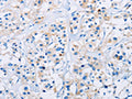 The image on the left is immunohistochemistry of paraffin-embedded Human thyroid cancer tissue using CSB-PA070366(CD33 Antibody) at dilution 1/30, on the right is treated with fusion protein. (Original magnification: ×200)
