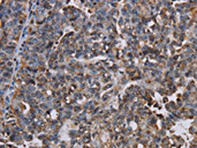 The image on the left is immunohistochemistry of paraffin-embedded Human ovarian cancer tissue using CSB-PA070468(LBR Antibody) at dilution 1/50, on the right is treated with fusion protein. (Original magnification: ×200)