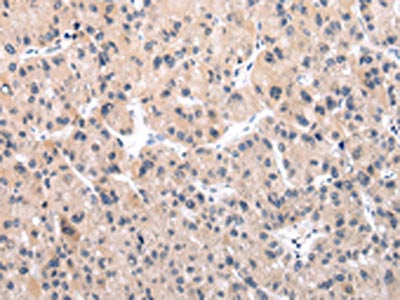 The image on the left is immunohistochemistry of paraffin-embedded Human liver cancer tissue using CSB-PA070545(IGF1 Antibody) at dilution 1/30, on the right is treated with synthetic peptide. (Original magnification: ×200)