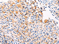The image on the left is immunohistochemistry of paraffin-embedded Human gastic cancer tissue using CSB-PA070773(PGBD1 Antibody) at dilution 1/20, on the right is treated with fusion protein. (Original magnification: ×200)