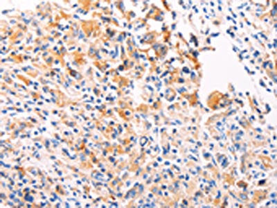 The image on the left is immunohistochemistry of paraffin-embedded Human gastic cancer tissue using CSB-PA070773(PGBD1 Antibody) at dilution 1/20, on the right is treated with fusion protein. (Original magnification: ×200)