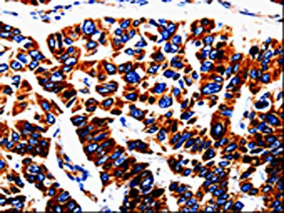 The image is immunohistochemistry of paraffin-embedded Human lung cancer tissue using CSB-PA070871(UTS2 Antibody) at dilution 1/50. (Original magnification: ×200)