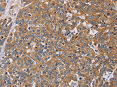 The image on the left is immunohistochemistry of paraffin-embedded Human esophagus cancer tissue using CSB-PA070925(ACTN4 Antibody) at dilution 1/60, on the right is treated with fusion protein. (Original magnification: X200)