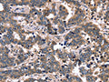 The image on the left is immunohistochemistry of paraffin-embedded Human liver cancer tissue using CSB-PA070949(FGFR1OP2 Antibody) at dilution 1/40, on the right is treated with fusion protein. (Original magnification: ×200)