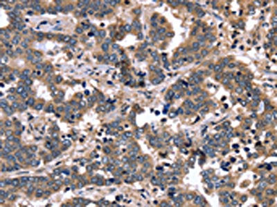 The image on the left is immunohistochemistry of paraffin-embedded Human liver cancer tissue using CSB-PA070949(FGFR1OP2 Antibody) at dilution 1/40, on the right is treated with fusion protein. (Original magnification: ×200)