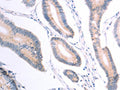 The image on the left is immunohistochemistry of paraffin-embedded Human colon cancer tissue using CSB-PA071125(VHL Antibody) at dilution 1/40, on the right is treated with fusion protein. (Original magnification: ×200)