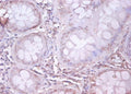 Immunohistochemistry of paraffin-embedded human colon cancer using CSB-PA07174A0Rb at dilution of 1:100