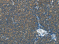 The image on the left is immunohistochemistry of paraffin-embedded Human lymphoma tissue using CSB-PA072110(IL1R1 Antibody) at dilution 1/30, on the right is treated with fusion protein. (Original magnification: ×200)
