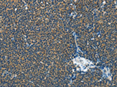 The image on the left is immunohistochemistry of paraffin-embedded Human lymphoma tissue using CSB-PA072110(IL1R1 Antibody) at dilution 1/30, on the right is treated with fusion protein. (Original magnification: ×200)