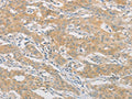 The image on the left is immunohistochemistry of paraffin-embedded Human gastic cancer tissue using CSB-PA072130(HIPK4 Antibody) at dilution 1/30, on the right is treated with fusion protein. (Original magnification: ×200)