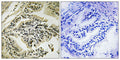 Immunohistochemical analysis of paraffin-embedded human prostate carcinoma tissue using PEK/PERK (Phospho-Thr982) antibody (left)or the same antibody preincubated with blocking peptide (right).