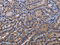 The image on the left is immunohistochemistry of paraffin-embedded Human thyroid cancer tissue using CSB-PA072616(TRPM8 Antibody) at dilution 1/30, on the right is treated with fusion protein. (Original magnification: ×200)