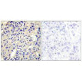 Immunohistochemistry analysis of paraffin-embedded human breast carcinoma tissue using Collagen V α2 antibody.