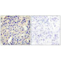 Immunohistochemistry analysis of paraffin-embedded human breast carcinoma tissue using Collagen V α2 antibody.