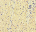 Immunohistochemistry of paraffin-embedded human liver cancer using CSB-PA07279A0Rb at dilution of 1:100