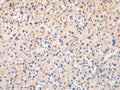 The image on the left is immunohistochemistry of paraffin-embedded Human liver cancer tissue using CSB-PA072803(APLN Antibody) at dilution 1/20, on the right is treated with synthetic peptide. (Original magnification: ×200)