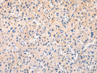 The image on the left is immunohistochemistry of paraffin-embedded Human liver cancer tissue using CSB-PA072803(APLN Antibody) at dilution 1/20, on the right is treated with synthetic peptide. (Original magnification: ×200)