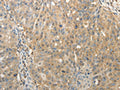 The image on the left is immunohistochemistry of paraffin-embedded Human ovarian cancer tissue using CSB-PA072816(SULT1E1 Antibody) at dilution 1/30, on the right is treated with fusion protein. (Original magnification: ×200)