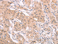 The image on the left is immunohistochemistry of paraffin-embedded Human breast cancer tissue using CSB-PA072901(ADAM11 Antibody) at dilution 1/40, on the right is treated with synthetic peptide. (Original magnification: ×200)