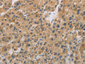 The image on the left is immunohistochemistry of paraffin-embedded Human liver cancer tissue using CSB-PA072935(CYFIP2 Antibody) at dilution 1/25, on the right is treated with fusion protein. (Original magnification: ×200)