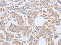 The image on the left is immunohistochemistry of paraffin-embedded Human breast cancer tissue using CSB-PA072974(ABHD5 Antibody) at dilution 1/10, on the right is treated with fusion protein. (Original magnification: ×200)