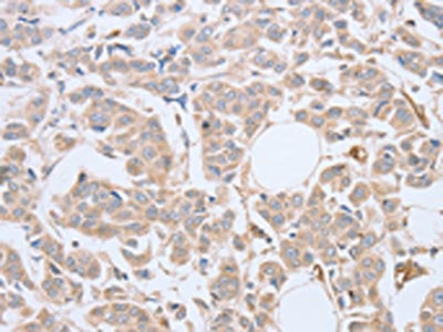 The image on the left is immunohistochemistry of paraffin-embedded Human breast cancer tissue using CSB-PA072974(ABHD5 Antibody) at dilution 1/10, on the right is treated with fusion protein. (Original magnification: ×200)