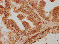 IHC image of CSB-PA07309A0Rb diluted at 1:600 and staining in paraffin-embedded human prostate cancer performed on a Leica BondTM system. After dewaxing and hydration, antigen retrieval was mediated by high pressure in a citrate buffer (pH 6.0). Section was blocked with 10% normal goat serum 30min at RT. Then primary antibody (1% BSA) was incubated at 4&deg;C overnight. The primary is detected by a biotinylated secondary antibody and visualized using an HRP conjugated SP system.