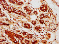 IHC image of CSB-PA07315A0Rb diluted at 1:400 and staining in paraffin-embedded human breast cancer performed on a Leica BondTM system. After dewaxing and hydration, antigen retrieval was mediated by high pressure in a citrate buffer (pH 6.0). Section was blocked with 10% normal goat serum 30min at RT. Then primary antibody (1% BSA) was incubated at 4&deg;C overnight. The primary is detected by a biotinylated secondary antibody and visualized using an HRP conjugated SP system.