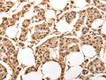 The image on the left is immunohistochemistry of paraffin-embedded Human breast cancer tissue using CSB-PA073168(ACO2 Antibody) at dilution 1/30, on the right is treated with synthetic peptide. (Original magnification: ×200)