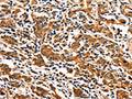 The image on the left is immunohistochemistry of paraffin-embedded Human gastic cancer tissue using CSB-PA073350(ITGAM Antibody) at dilution 1/10, on the right is treated with synthetic peptide. (Original magnification: ×200)
