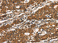 The image on the left is immunohistochemistry of paraffin-embedded Human gastic cancer tissue using CSB-PA073427(KLRC1 Antibody) at dilution 1/20, on the right is treated with fusion protein. (Original magnification: ×200)