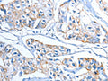 The image on the left is immunohistochemistry of paraffin-embedded Human breast cancer tissue using CSB-PA073477(ADSL Antibody) at dilution 1/20, on the right is treated with fusion protein. (Original magnification: ×200)