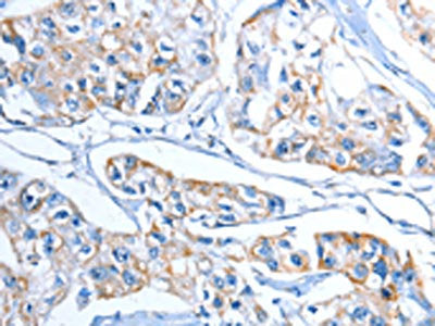 The image on the left is immunohistochemistry of paraffin-embedded Human breast cancer tissue using CSB-PA073477(ADSL Antibody) at dilution 1/20, on the right is treated with fusion protein. (Original magnification: ×200)