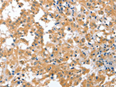 The image on the left is immunohistochemistry of paraffin-embedded Human thyroid cancer tissue using CSB-PA073505(CDR2 Antibody) at dilution 1/60, on the right is treated with fusion protein. (Original magnification: ×200)