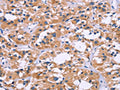 The image on the left is immunohistochemistry of paraffin-embedded Human thyroid cancer tissue using CSB-PA073575(ZEB2 Antibody) at dilution 1/60, on the right is treated with fusion protein. (Original magnification: ×200)