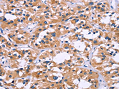 The image on the left is immunohistochemistry of paraffin-embedded Human thyroid cancer tissue using CSB-PA073575(ZEB2 Antibody) at dilution 1/60, on the right is treated with fusion protein. (Original magnification: ×200)