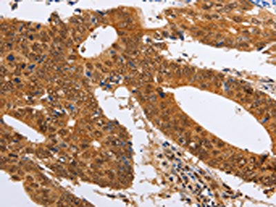 The image on the left is immunohistochemistry of paraffin-embedded Human colon cancer tissue using CSB-PA073605(PSMD8 Antibody) at dilution 1/25, on the right is treated with fusion protein. (Original magnification: ×200)