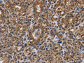 The image on the left is immunohistochemistry of paraffin-embedded Human thyroid cancer tissue using CSB-PA073623(GALK1 Antibody) at dilution 1/40, on the right is treated with fusion protein. (Original magnification: ×200)