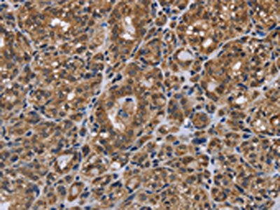 The image on the left is immunohistochemistry of paraffin-embedded Human thyroid cancer tissue using CSB-PA073623(GALK1 Antibody) at dilution 1/40, on the right is treated with fusion protein. (Original magnification: ×200)