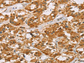 The image on the left is immunohistochemistry of paraffin-embedded Human thyroid cancer tissue using CSB-PA073786(DLL4 Antibody) at dilution 1/40, on the right is treated with fusion protein. (Original magnification: ×200)
