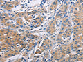 The image on the left is immunohistochemistry of paraffin-embedded Human lung cancer tissue using CSB-PA074141(AGBL5 Antibody) at dilution 1/30, on the right is treated with fusion protein. (Original magnification: ×200)