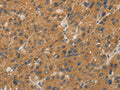 The image on the left is immunohistochemistry of paraffin-embedded Human liver cancer tissue using CSB-PA074176(CYP17A1 Antibody) at dilution 1/20, on the right is treated with fusion protein. (Original magnification: ×200)