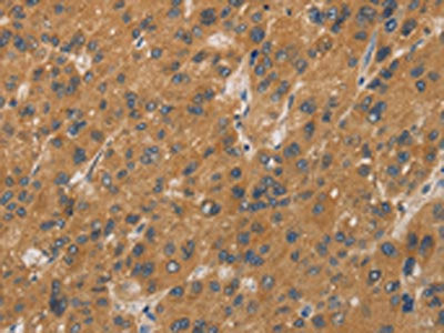 The image on the left is immunohistochemistry of paraffin-embedded Human liver cancer tissue using CSB-PA074176(CYP17A1 Antibody) at dilution 1/20, on the right is treated with fusion protein. (Original magnification: ×200)