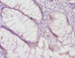 Immunohistochemistry of paraffin-embedded human colon cancer using CSB-PA07419A0Rb at dilution of 1:100