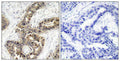 Immunohistochemical analysis of paraffin-embedded human breast carcinoma tissue using p21Cip1(Phospho-Thr145) Antibody(left) or the same antibody preincubated with blocking peptide(right).