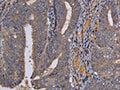 The image on the left is immunohistochemistry of paraffin-embedded Human colon cancer tissue using CSB-PA074697(REG3G Antibody) at dilution 1/60, on the right is treated with fusion protein. (Original magnification: X200)
