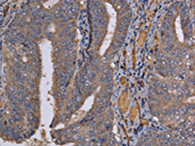 The image on the left is immunohistochemistry of paraffin-embedded Human colon cancer tissue using CSB-PA074697(REG3G Antibody) at dilution 1/60, on the right is treated with fusion protein. (Original magnification: X200)