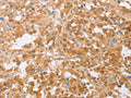 The image on the left is immunohistochemistry of paraffin-embedded Human thyroid cancer tissue using CSB-PA075339(CDKN2C Antibody) at dilution 1/25, on the right is treated with fusion protein. (Original magnification: ×200)