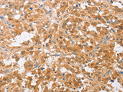 The image on the left is immunohistochemistry of paraffin-embedded Human thyroid cancer tissue using CSB-PA075339(CDKN2C Antibody) at dilution 1/25, on the right is treated with fusion protein. (Original magnification: ×200)
