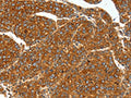 The image on the left is immunohistochemistry of paraffin-embedded Human liver cancer tissue using CSB-PA075436(SSTR1 Antibody) at dilution 1/40, on the right is treated with synthetic peptide. (Original magnification: ×200)